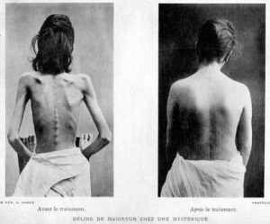 L’encadrement médical de l’anorexie répond à des enjeux politiques et scientifiques de normalisation de la puberté.