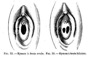 En affirmant au XIXe siècle l’existence de l’hymen chez toutes les femmes, les médecins renforcent les interdits pesant sur la sexualité féminine.